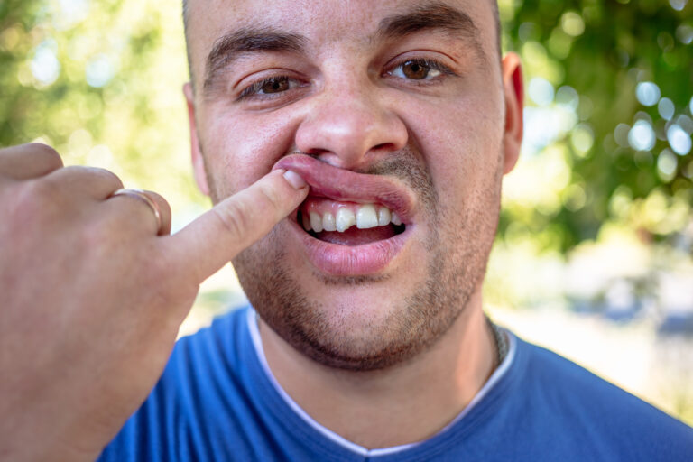 man in a blue tooth exposing his chipped tooth