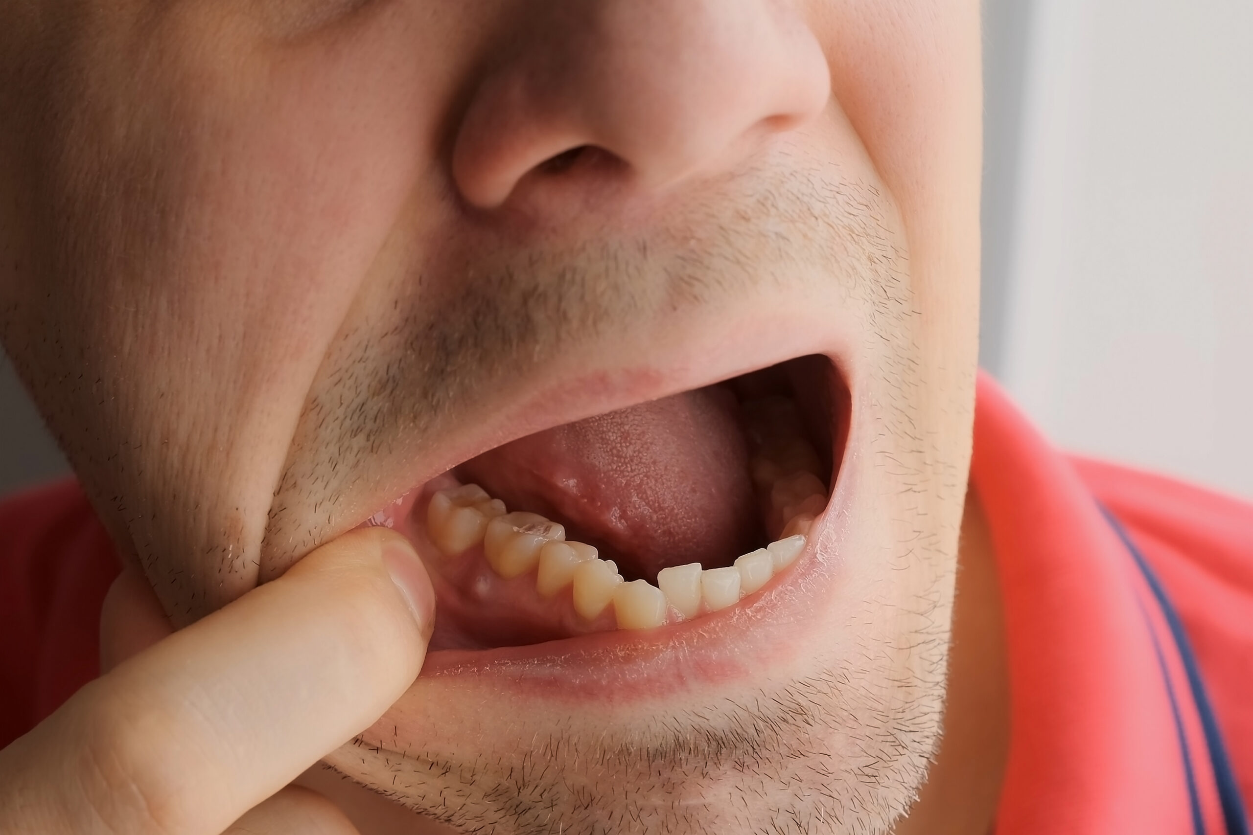 Man is showing tooth in mouth with a dental abscess fistula on gum, closeup view.